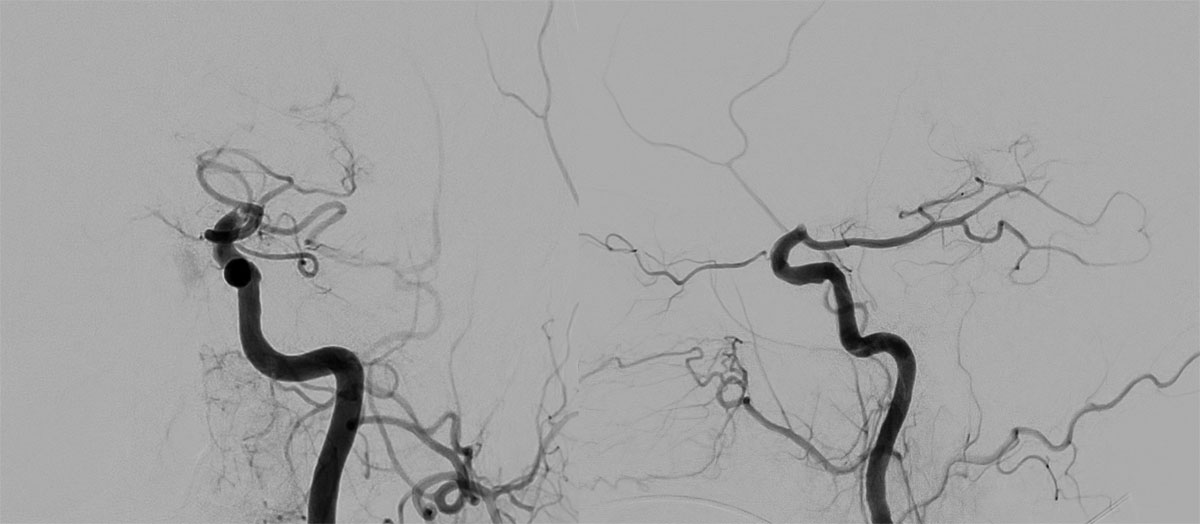 First-Pass Complete Reperfusion in a Left Carotid-T Occlusion Using an Aspiration Catheter and XL Delivery Catheter - Figure 4