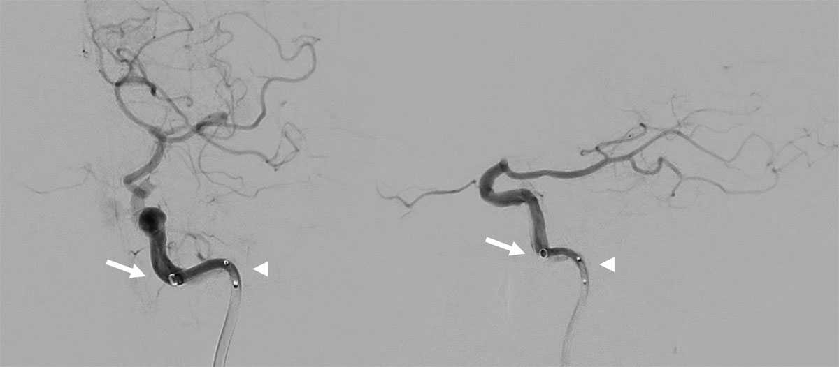 First-Pass Complete Reperfusion in a Left Carotid-T Occlusion Using an Aspiration Catheter and XL Delivery Catheter - Figure 5