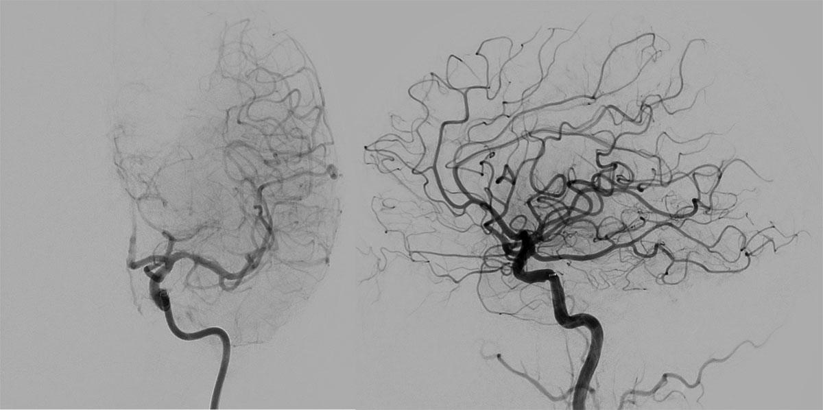 First-Pass Complete Reperfusion in a Left Carotid-T Occlusion Using an Aspiration Catheter and XL Delivery Catheter - Figure 6