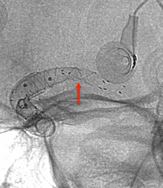 ica-occlusion-figure10