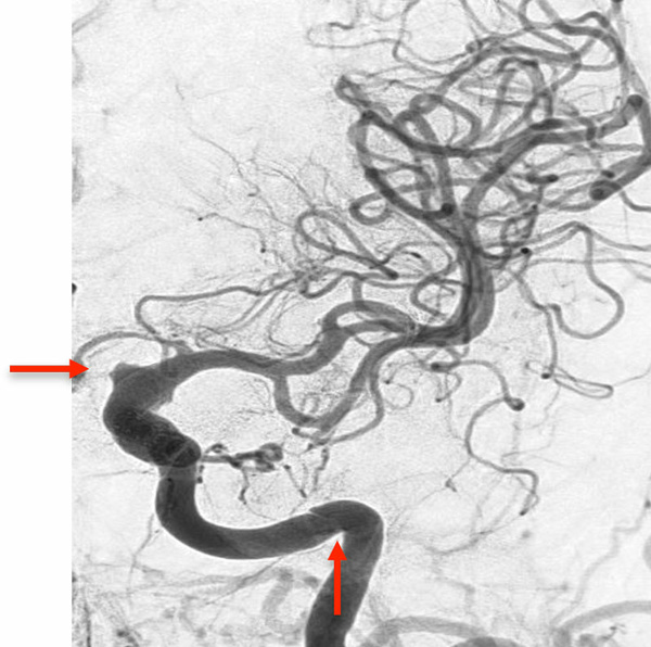 ica-occlusion-figure11