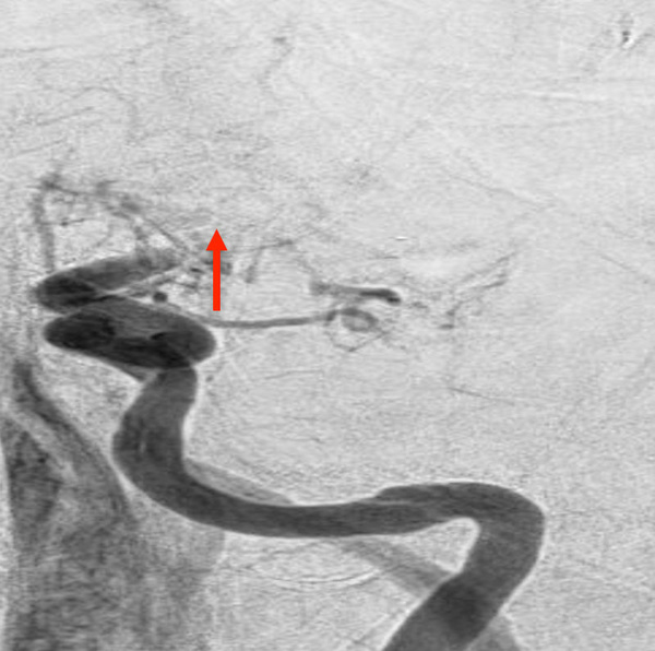 ica-occlusion-figure12