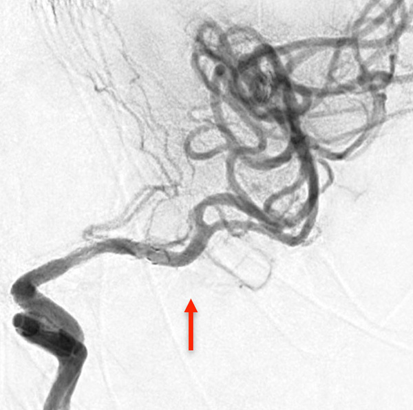 ica-occlusion-figure13