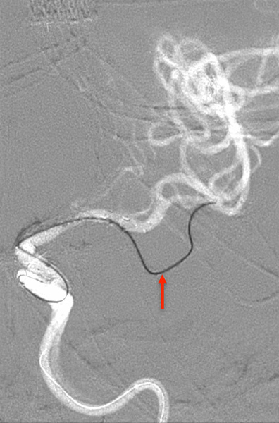 ica-occlusion-figure14