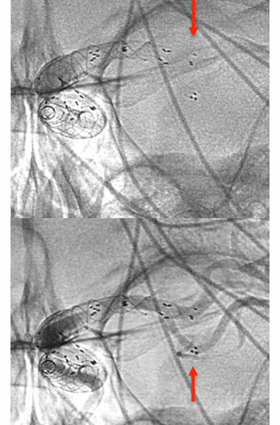 ica-occlusion-figure15