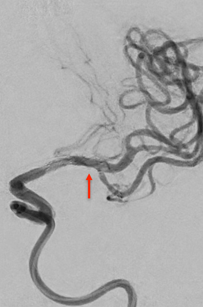 ica-occlusion-figure16
