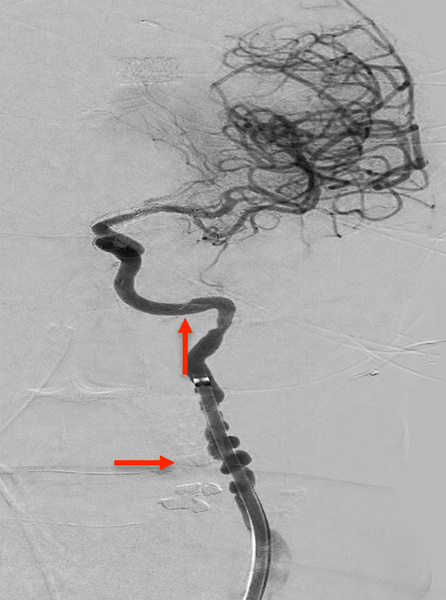 ica-occlusion-figure17