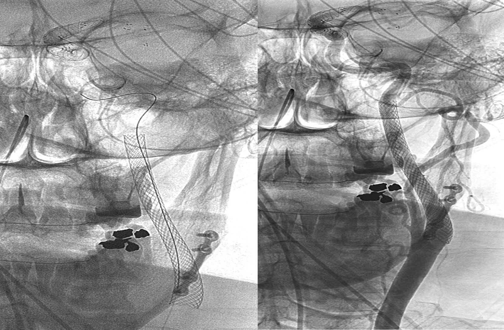 ica-occlusion-figure18