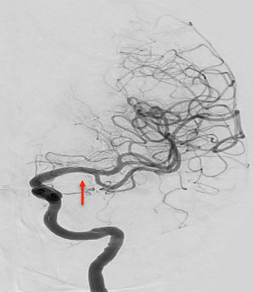 ica-occlusion-figure19
