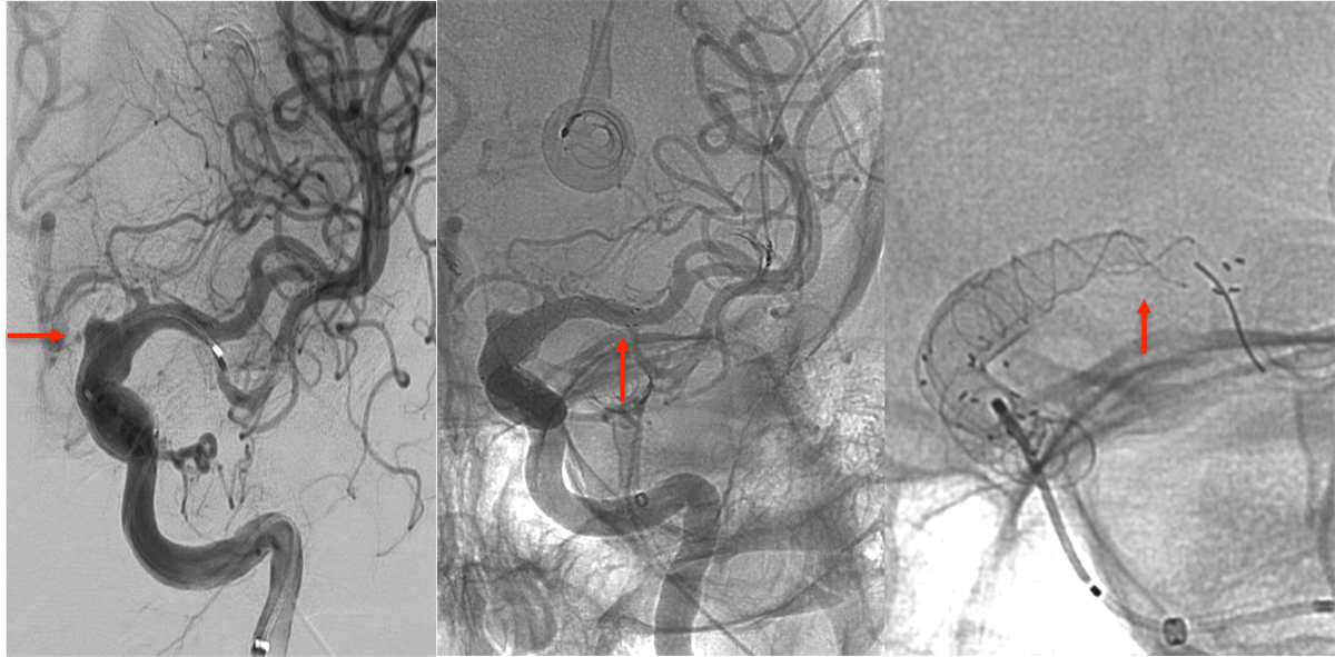 ica-occlusion-figure2