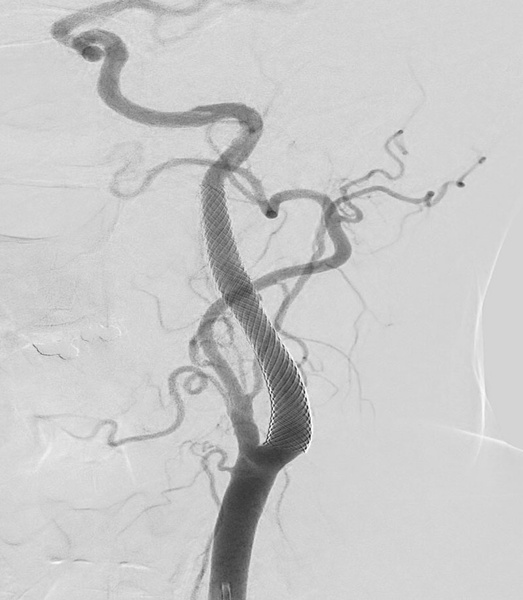ica-occlusion-figure20