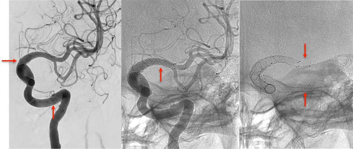 ica-occlusion-figure21