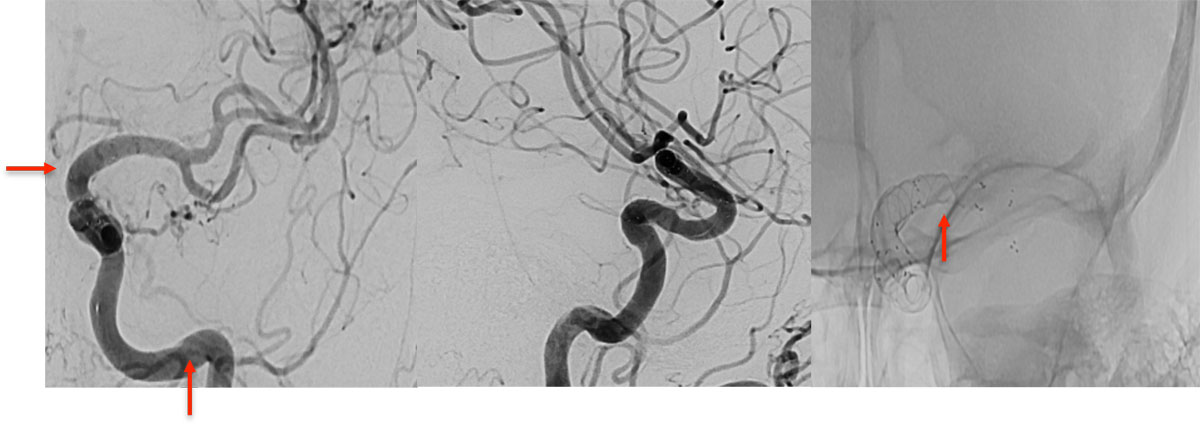 ica-occlusion-figure22