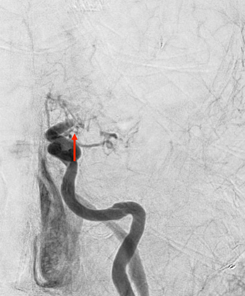 ica-occlusion-figure3