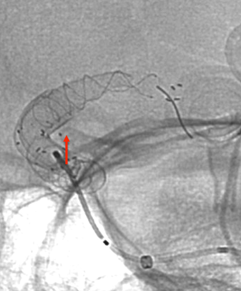 ica-occlusion-figure4
