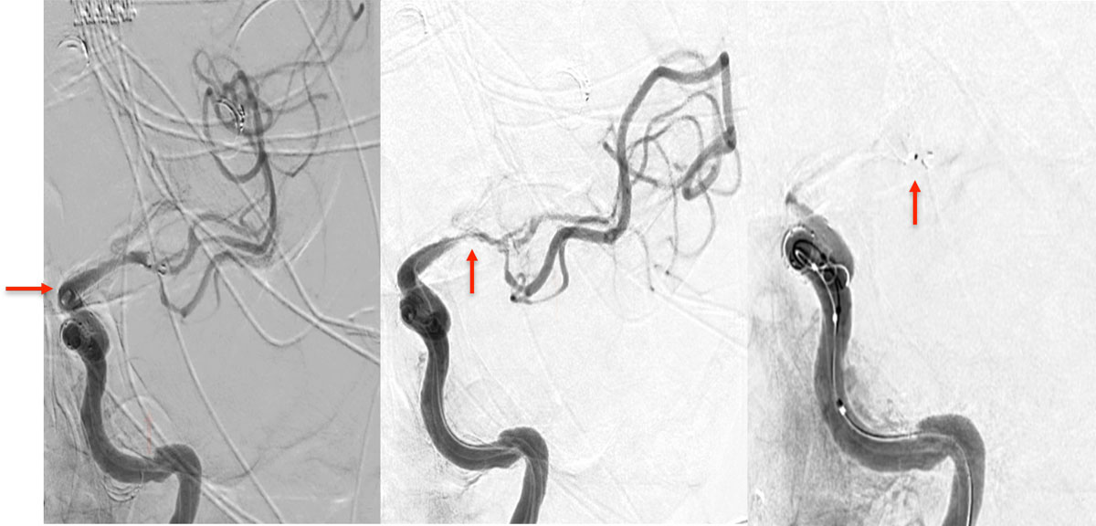 ica-occlusion-figure7