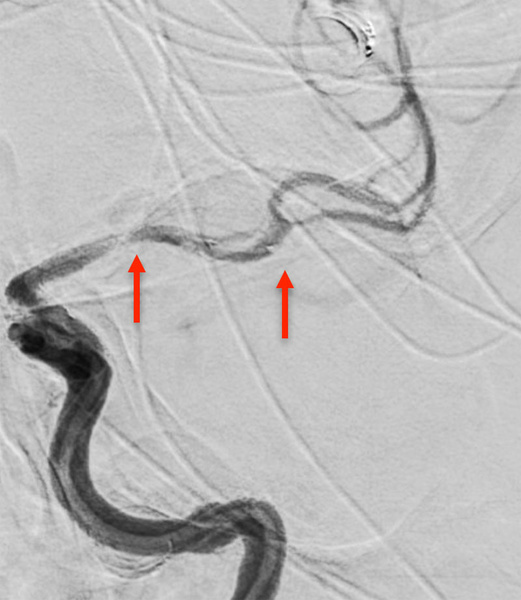 ica-occlusion-figure8
