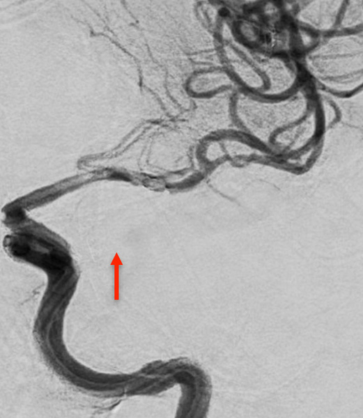 ica-occlusion-figure9