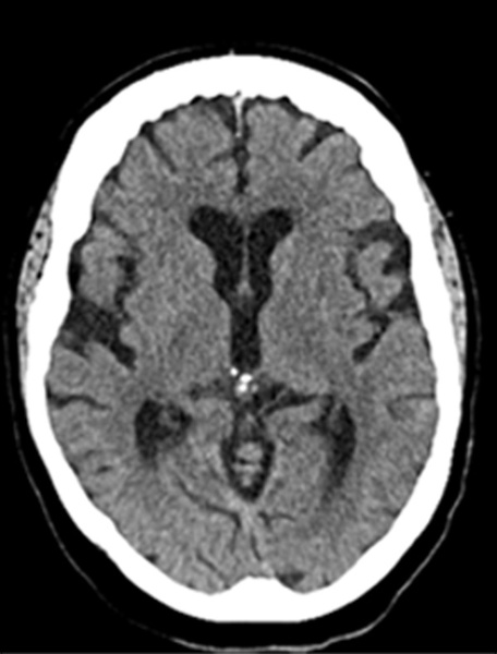 single-pass-large-bore-aspiration-for-acute-left-carotid-t-occlusion-figure1