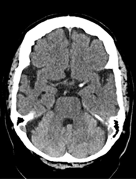 single-pass-large-bore-aspiration-for-acute-left-carotid-t-occlusion-figure2