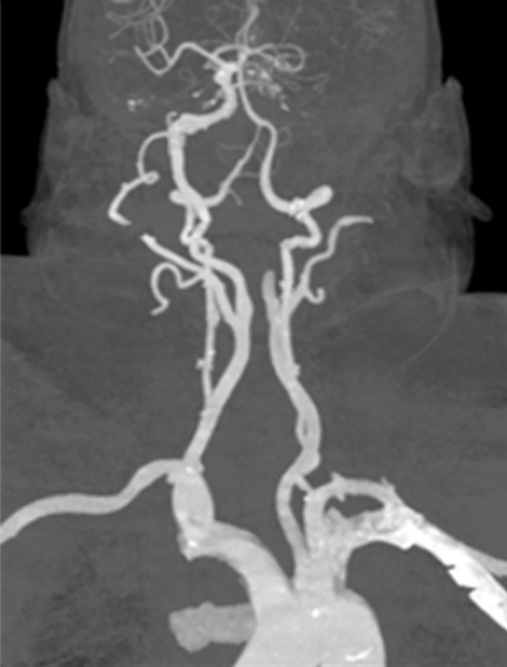 single-pass-large-bore-aspiration-for-acute-left-carotid-t-occlusion-figure3