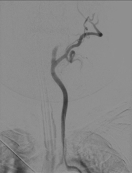 single-pass-large-bore-aspiration-for-acute-left-carotid-t-occlusion-figure4