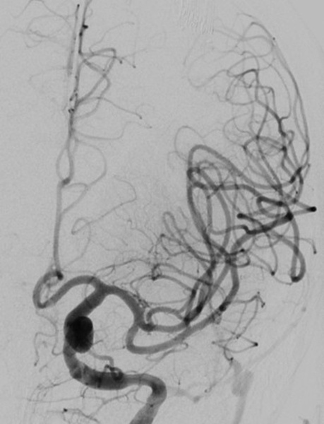 single-pass-large-bore-aspiration-for-acute-left-carotid-t-occlusion-figure5