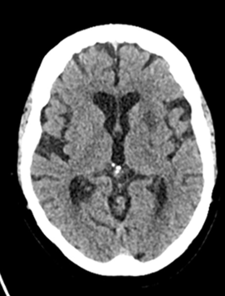 single-pass-large-bore-aspiration-for-acute-left-carotid-t-occlusion-figure7