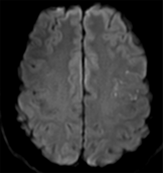 slow-deconstructive-approach-in-a-patient-with-acute-stroke-and-fusiform-mca-aneurysm-figure1