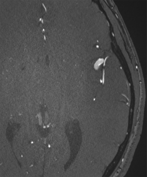 slow-deconstructive-approach-in-a-patient-with-acute-stroke-and-fusiform-mca-aneurysm-figure2