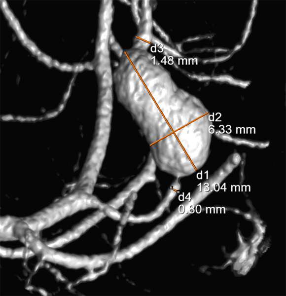 slow-deconstructive-approach-in-a-patient-with-acute-stroke-and-fusiform-mca-aneurysm-figure3