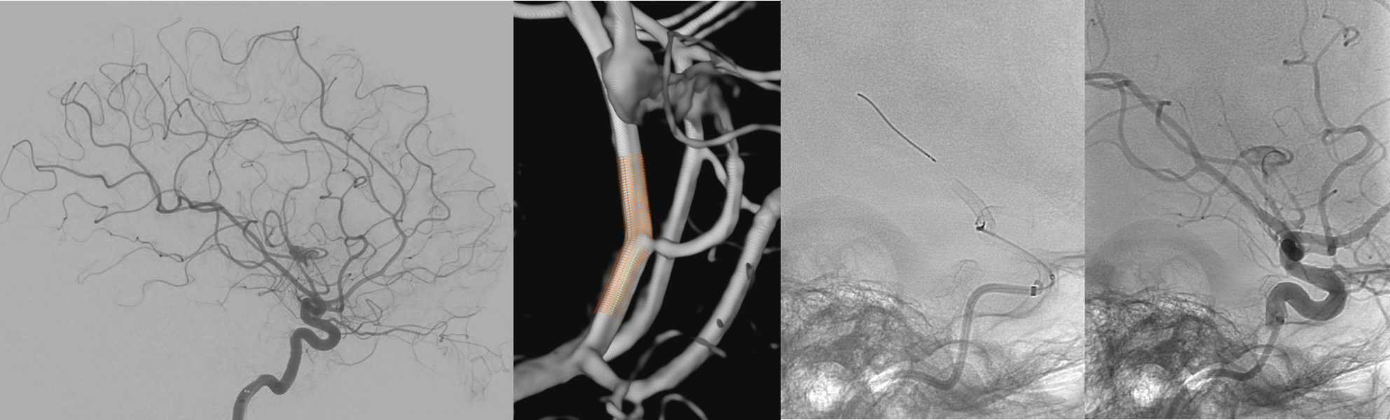 slow-deconstructive-approach-in-a-patient-with-acute-stroke-and-fusiform-mca-aneurysm-figure4