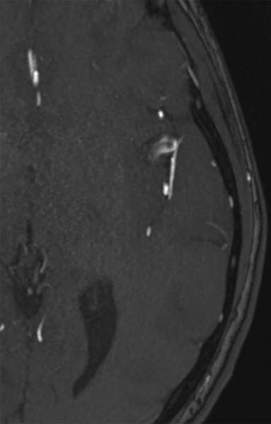 slow-deconstructive-approach-in-a-patient-with-acute-stroke-and-fusiform-mca-aneurysm-figure5