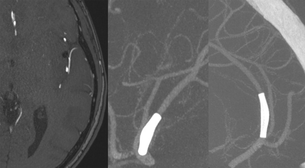 slow-deconstructive-approach-in-a-patient-with-acute-stroke-and-fusiform-mca-aneurysm-figure6