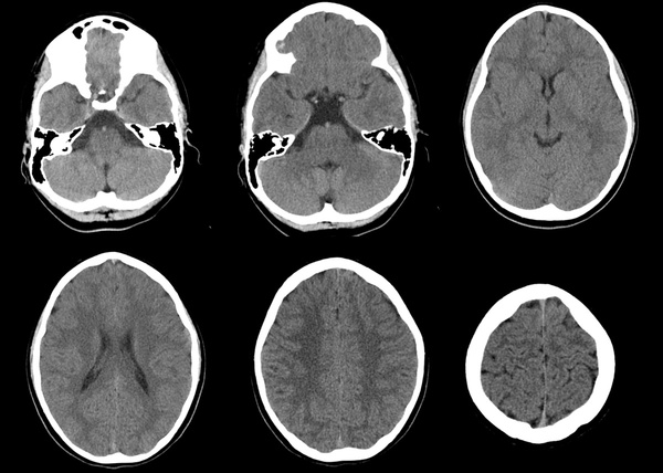 The-Youngest-Challenge-Emergency-Stenting-for-Pediatric-Ischemic-Stroke-figure1