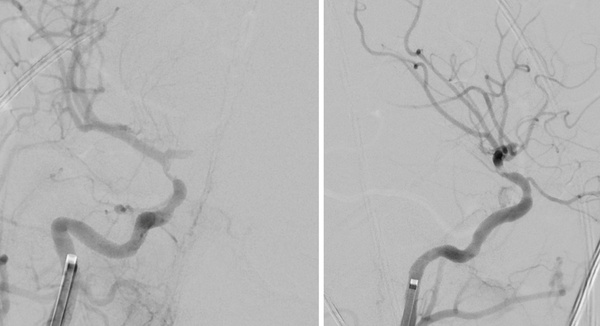 The-Youngest-Challenge-Emergency-Stenting-for-Pediatric-Ischemic-Stroke-figure10