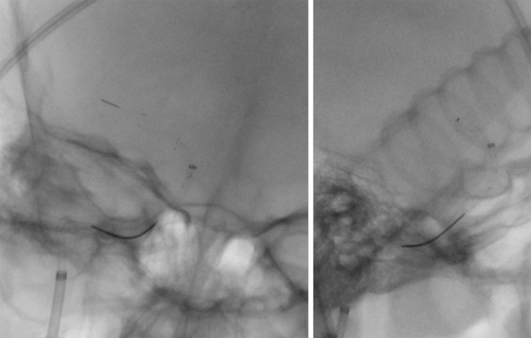 The-Youngest-Challenge-Emergency-Stenting-for-Pediatric-Ischemic-Stroke-figure11