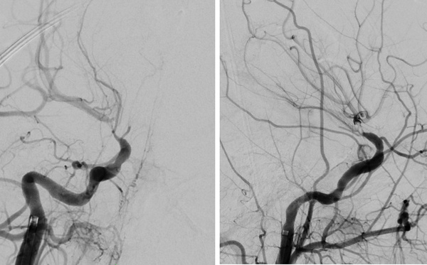 The-Youngest-Challenge-Emergency-Stenting-for-Pediatric-Ischemic-Stroke-figure12