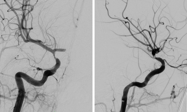 The-Youngest-Challenge-Emergency-Stenting-for-Pediatric-Ischemic-Stroke-figure13