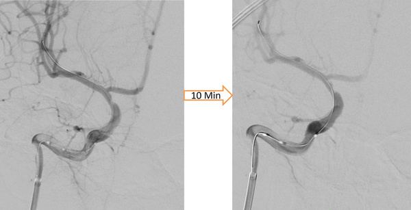 The-Youngest-Challenge-Emergency-Stenting-for-Pediatric-Ischemic-Stroke-figure14