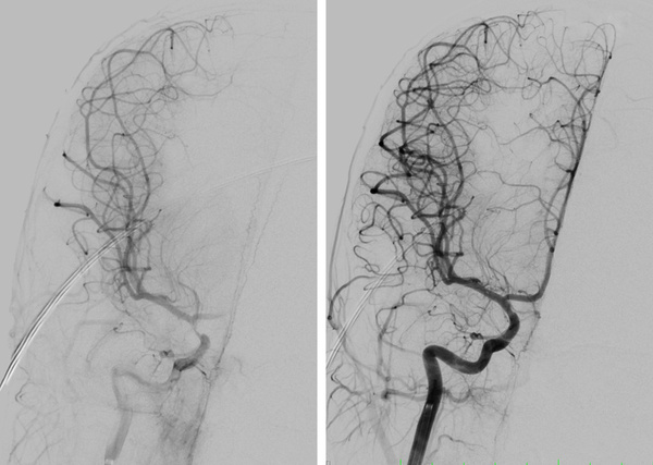 The-Youngest-Challenge-Emergency-Stenting-for-Pediatric-Ischemic-Stroke-figure15