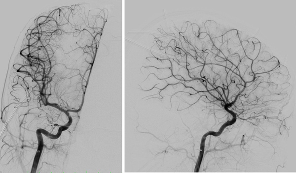The-Youngest-Challenge-Emergency-Stenting-for-Pediatric-Ischemic-Stroke-figure16