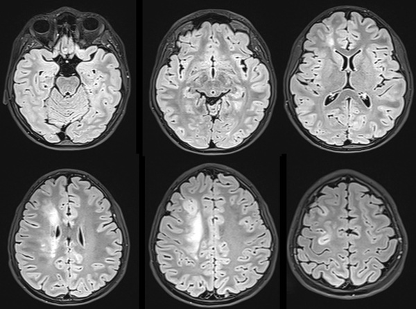 The-Youngest-Challenge-Emergency-Stenting-for-Pediatric-Ischemic-Stroke-figure17