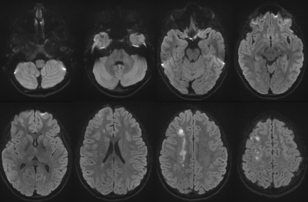 The-Youngest-Challenge-Emergency-Stenting-for-Pediatric-Ischemic-Stroke-figure2