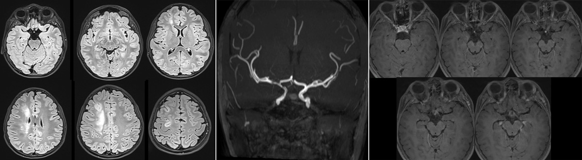The-Youngest-Challenge-Emergency-Stenting-for-Pediatric-Ischemic-Stroke-figure20