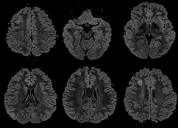 The-Youngest-Challenge-Emergency-Stenting-for-Pediatric-Ischemic-Stroke-figure3