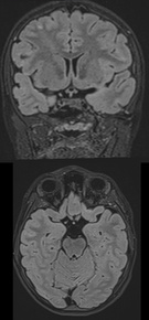 The-Youngest-Challenge-Emergency-Stenting-for-Pediatric-Ischemic-Stroke-figure4