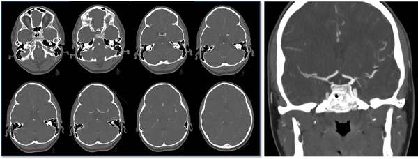 The-Youngest-Challenge-Emergency-Stenting-for-Pediatric-Ischemic-Stroke-figure5