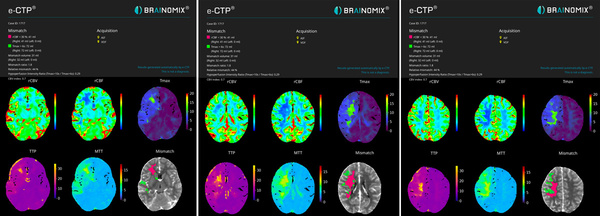 The-Youngest-Challenge-Emergency-Stenting-for-Pediatric-Ischemic-Stroke-figure7