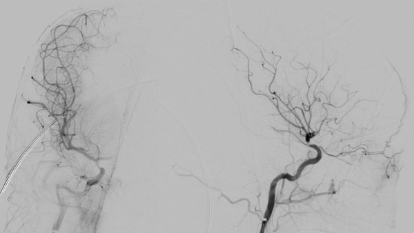 The-Youngest-Challenge-Emergency-Stenting-for-Pediatric-Ischemic-Stroke-figure8